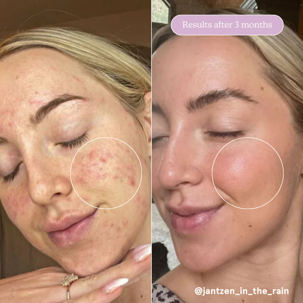 Blume Skin Care Meltdown Acne Oil Treatment 🇨🇦